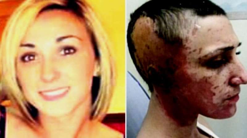 5. BEFORE AND AFTER ACID ATTACK ON A BRITISH BEAUTICIAN