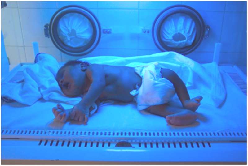 Jaundiced Baby Being Treated With Special Blue Light In An Incubator