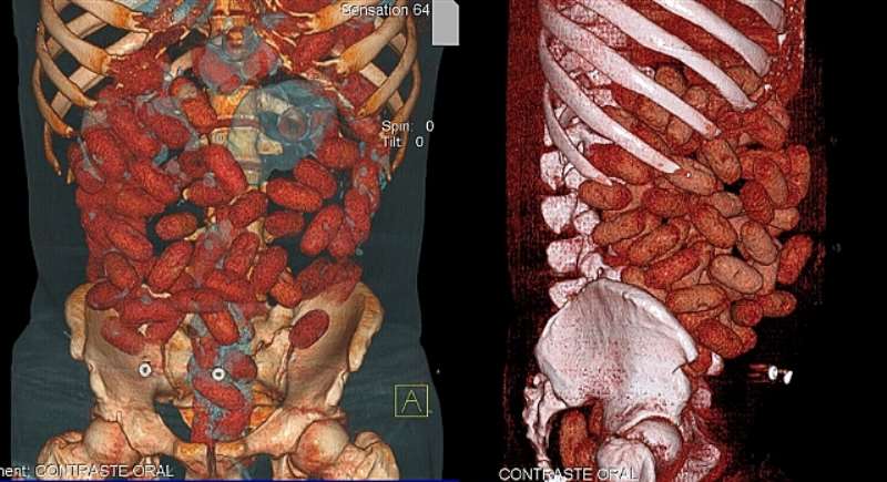 Handout medical image released by the Brazilian Federal Police showing bags with cocaine inside the gastrointestinal tract of a 20-year-old Irish national arrested by police at Congonhas airport in Sao Paulo, Brazil, on September 12. The man, identified only as P.B.B., was stopped whilst trying to board a flight outbound for Brussels with 72 bags containing almost a kilogram of the drug inside his intestines.