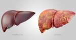 When the Keeper Falls Silent: How Liver Disease Can Hide in Plain Sight