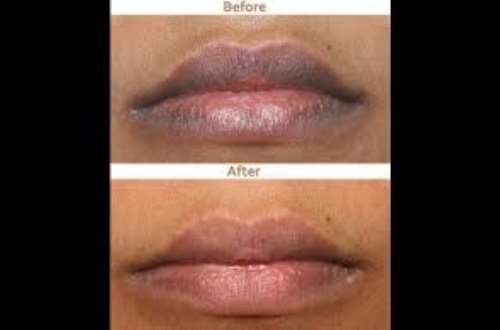 discoloration-near-lips-lipstutorial