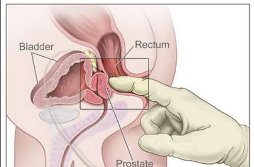 does testosterone cause prostate problems