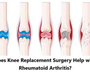 Does Knee Replacement Surgery Help with Rheumatoid Arthritis