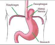 Hiatal Hernia