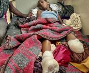 Iyerusalem, 10, needed both legs amputated after heavy shelling in Qarsole, Tigray, that also killed her brother. - - / AFP