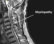 Understanding Cervical Myelopathy: A Neurosurgeons Insight