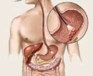 Tips To Prevent GI Cancer