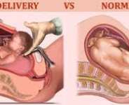 Choosing Between C-Section And Spontaneous Vaginal Birth
