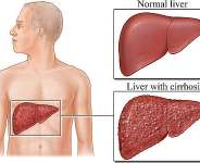 HEPATITIS B
