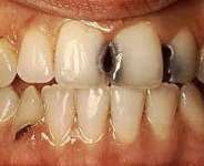 Why We Have To Brush Our Teeth With Fluoridated Toothpaste