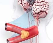 Recognizing the Symptoms and Signs of Stroke