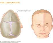 The significance of surgical intervention and raising public awareness regarding craniosynostosis