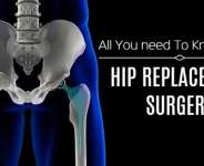 All You Need To Know About Total Hip Replacement.