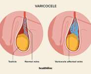 Male Infertility Risk: The importance of diagnosing and treating Varicocele – Expert reveals