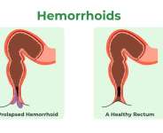 Why My Hemorrhoid Shrinks After Sex: A Physiological Perspective