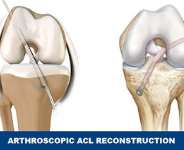 Knee Arthroscopic ACL reconstruction