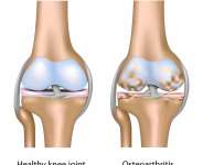 Why is knee arthritis common in India?