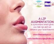 lip augmentation in delhi by dr. ajaya kashyap
