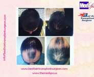 Hair Transplant in Delhi