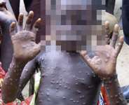 The Monkeypox Viral Infection
