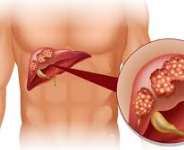 Liver Cancer (Hepatocellular Carcinoma)