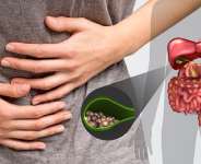 Gall stones