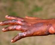 Burns Awareness: Our Attitude Towards Burn Injury, The Impact Of Burn Injury We Downplay