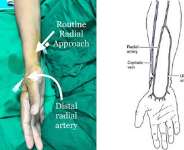 Better Approach For Angiography And Angioplasty
