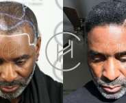The Differences Between Traditional and Afro Hair Transplants