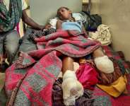 Iyerusalem, 10, needed both legs amputated after heavy shelling in Qarsole, Tigray, that also killed her brother. By - (AFP)