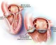 Heart Valve Replacement