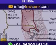 Ovarian Cancer