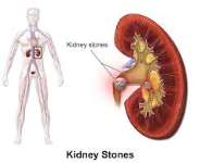 kidney stone