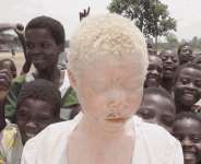 Acts of Discrimination against Albinos: Yusif Fatau’s educational dreams shattered