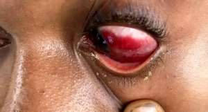 The victim with swelling around his eye