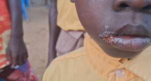Mysterious illness leaves children struggling to walk, hear in Mafi Kope