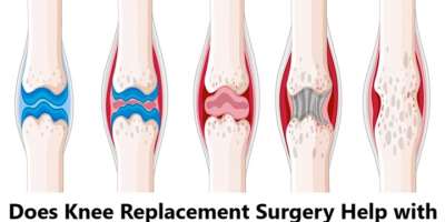 Does Knee Replacement Surgery Help with Rheumatoid Arthritis