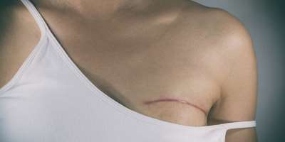 Breast Conservation Surgery -The new paradigm