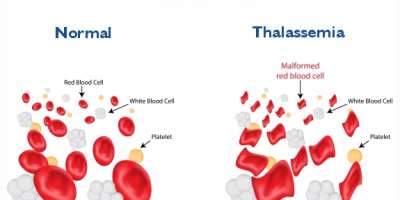Understanding Thalassemia: Causes, Treatment, and the Importance of Awareness