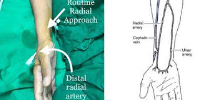Better Approach For Angiography And Angioplasty