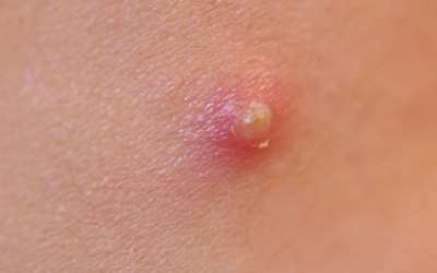 Home Remedies For Treating Boils