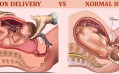 Choosing Between C Section And Spontaneous Vaginal Birth