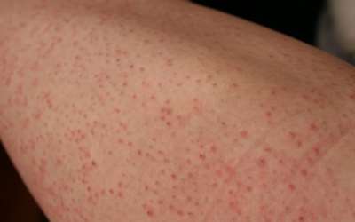 10 Tips To Prevent Ingrown Hair