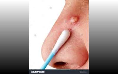 Boils Causes Symptoms Remedies