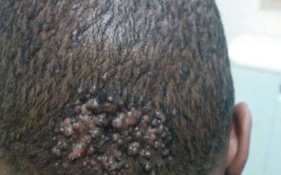 What Causes Keloids On The Head