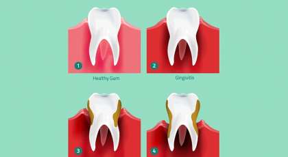 Can Gum Disease Affect Your Fertility?