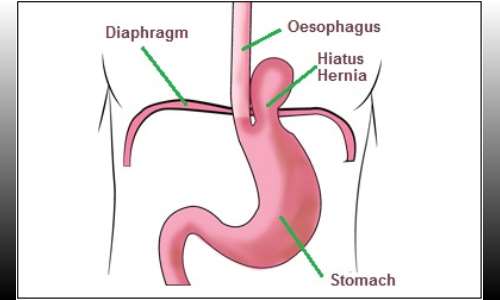 Hiatal Hernia