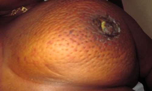 Do’s and Dont’s about Covid-19 vaccines for breast cancer patients