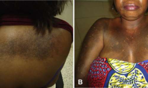 The damage bleaching can cause to the body