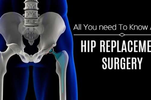 Hip Replacement Surgery In India Types Of Hip Replacement, 56% OFF